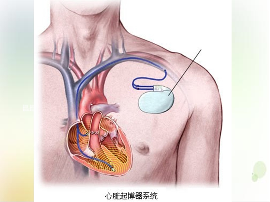 起搏器术前术后护理PPT优秀案例课件.ppt_第3页