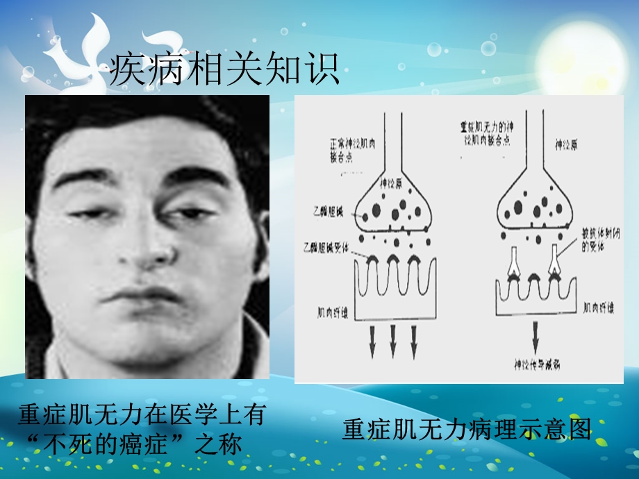 重症肌无力患者的护理ppt课件.ppt_第3页