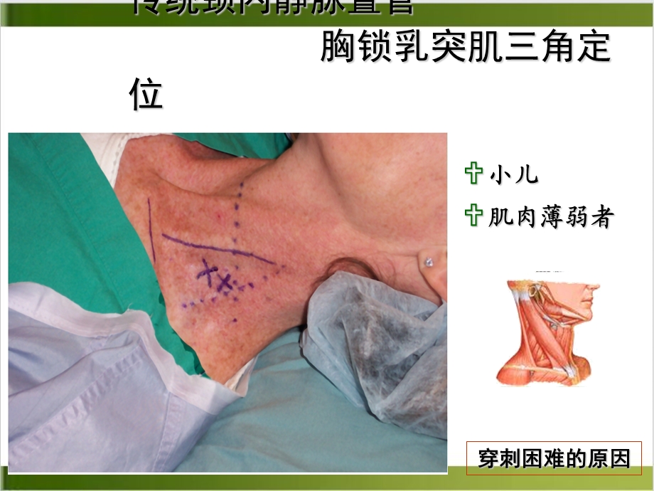 超声引导血管穿刺参考ppt课件.ppt_第3页