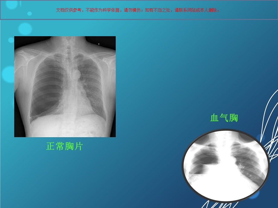 血气胸医学知识ppt课件.ppt_第3页