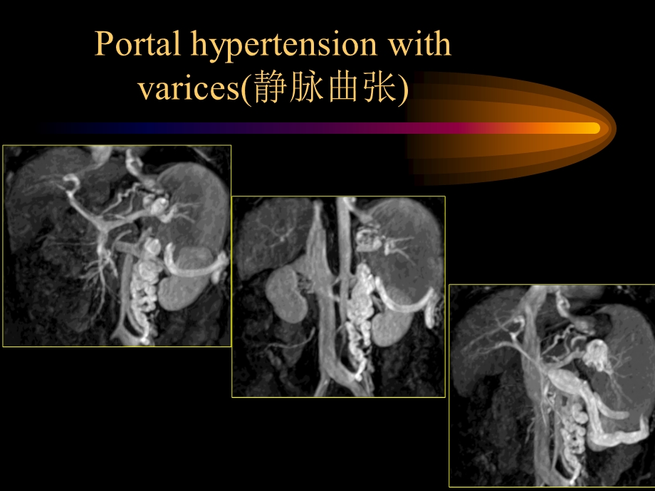 门静脉海绵样变讲义课件.ppt_第3页