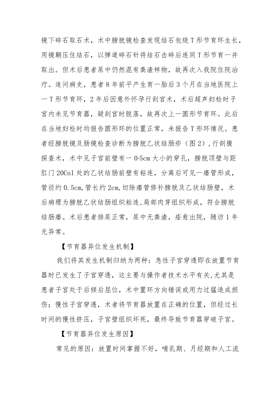 妇产科医师晋升副主任（主任）医师高级职称病例分析专题报告（节育器异位穿透膀胱）.docx_第3页