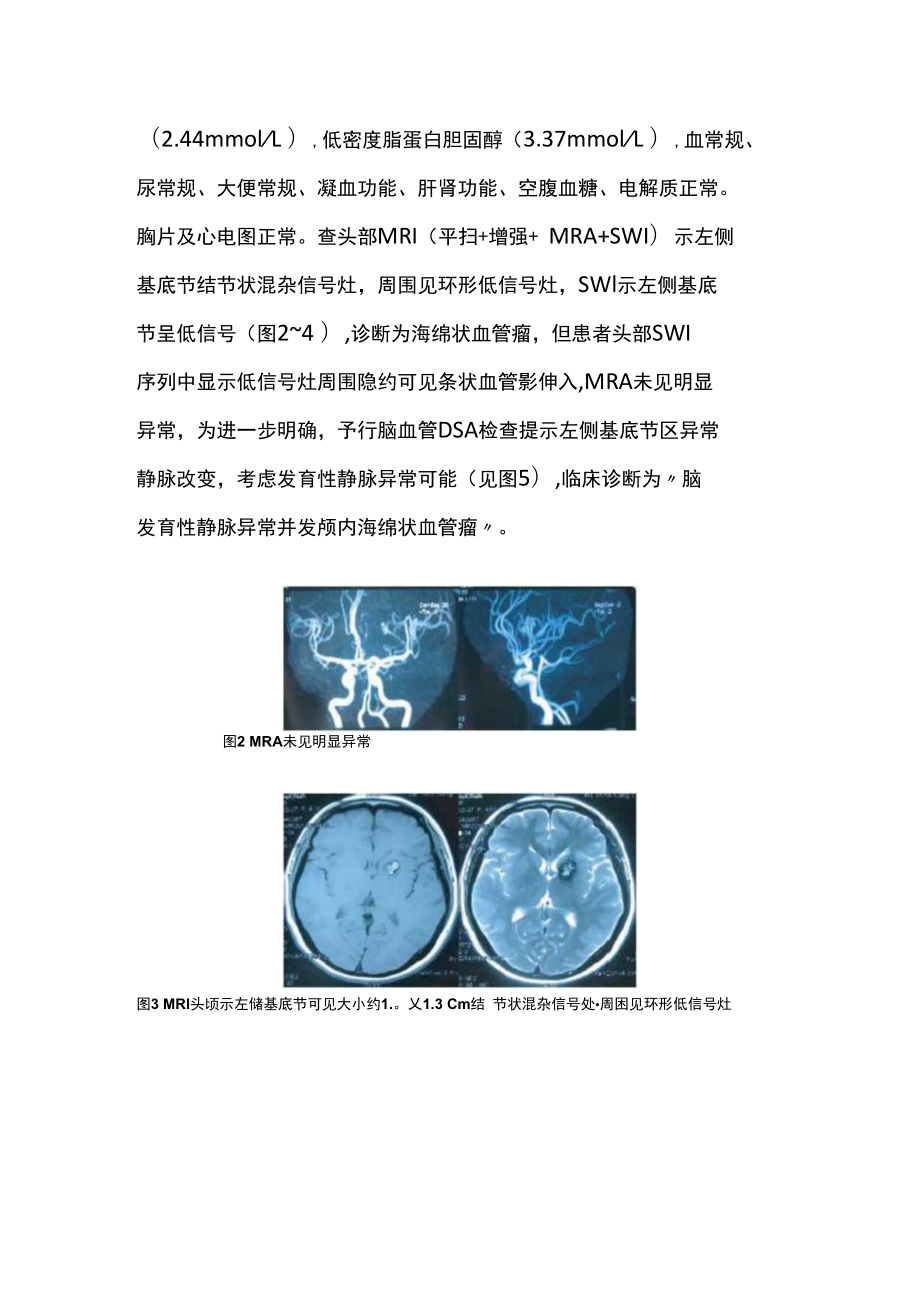 颅内脑发育性静脉异常并发海绵状血管瘤病例分析专题报告.docx_第3页