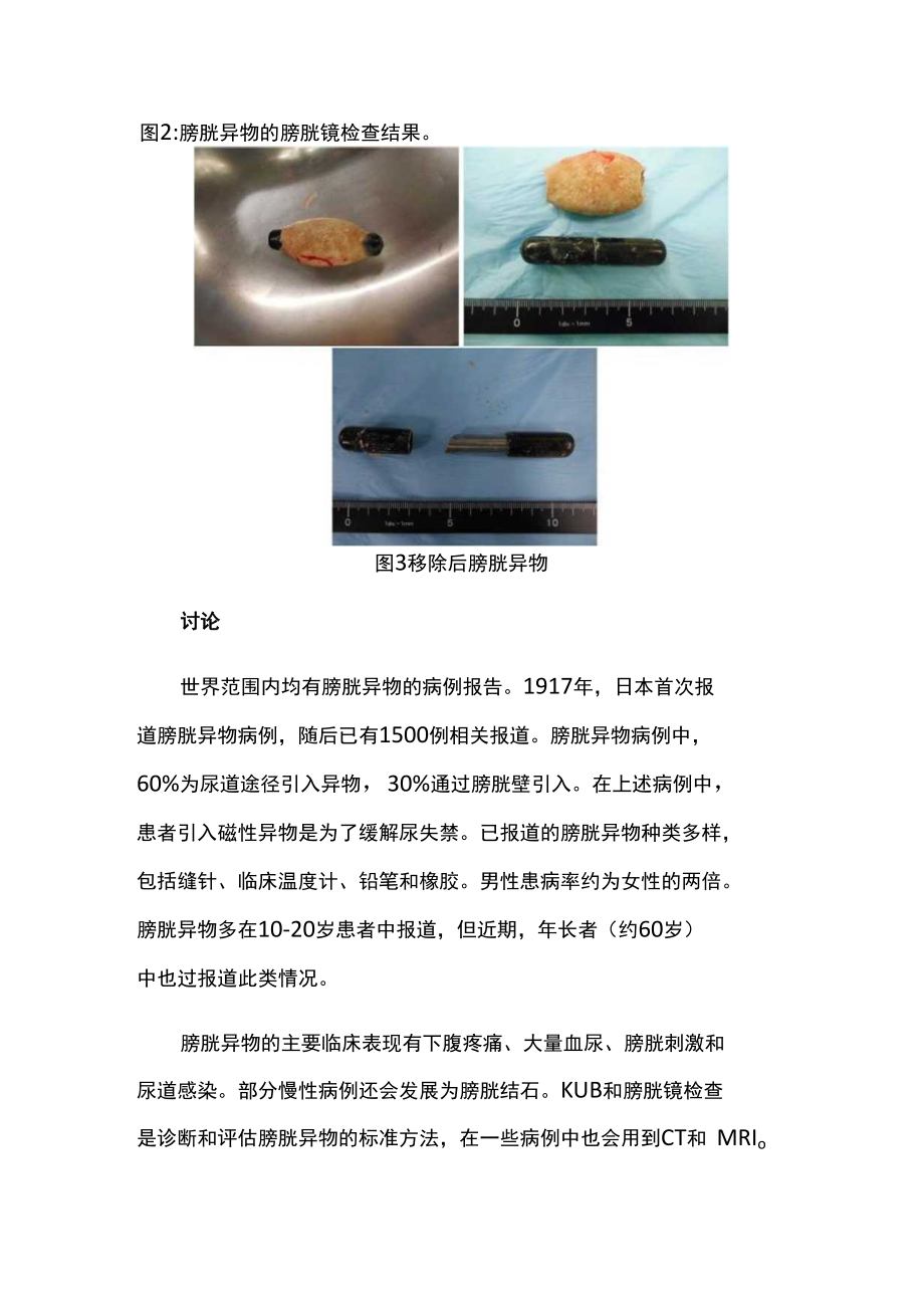 膀胱异物病例分析专题报告.docx_第2页