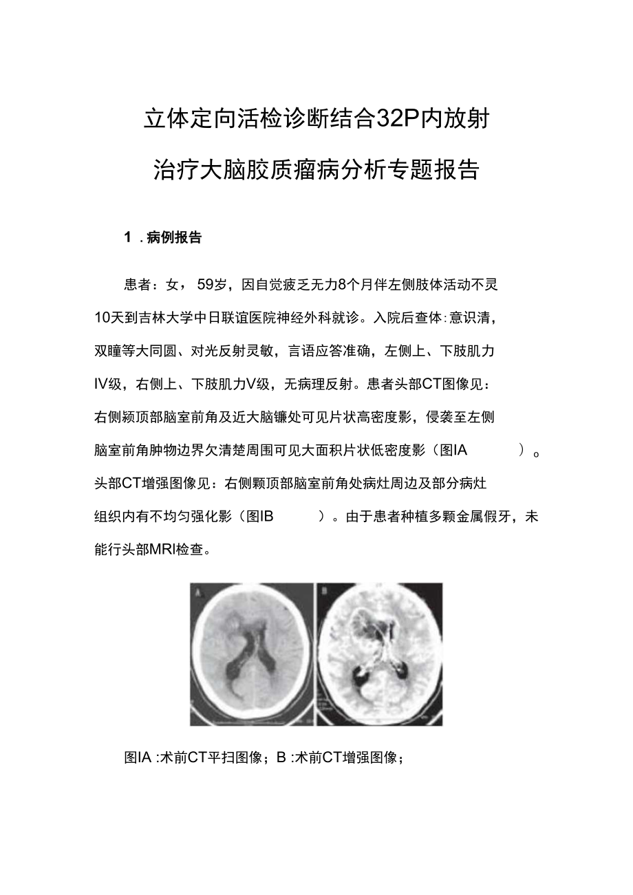 立体定向活检诊断结合32P内放射治疗大脑胶质瘤病分析专题报告.docx_第1页