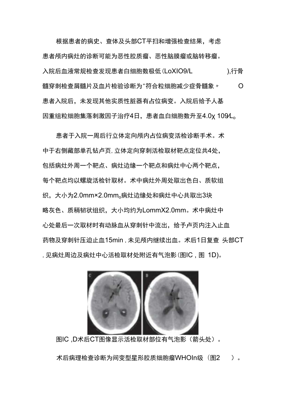立体定向活检诊断结合32P内放射治疗大脑胶质瘤病分析专题报告.docx_第2页
