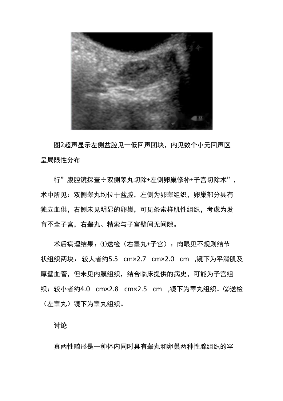 超声科医师晋升副主任（主任）医师例分析专题报告（超声诊断真两性畸形）.docx_第3页