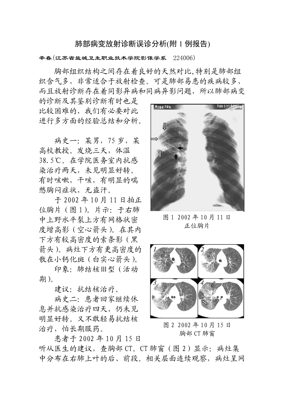 肺部病变放射诊断误诊分析doc-肺部病变放射诊断误诊一例.docx_第1页