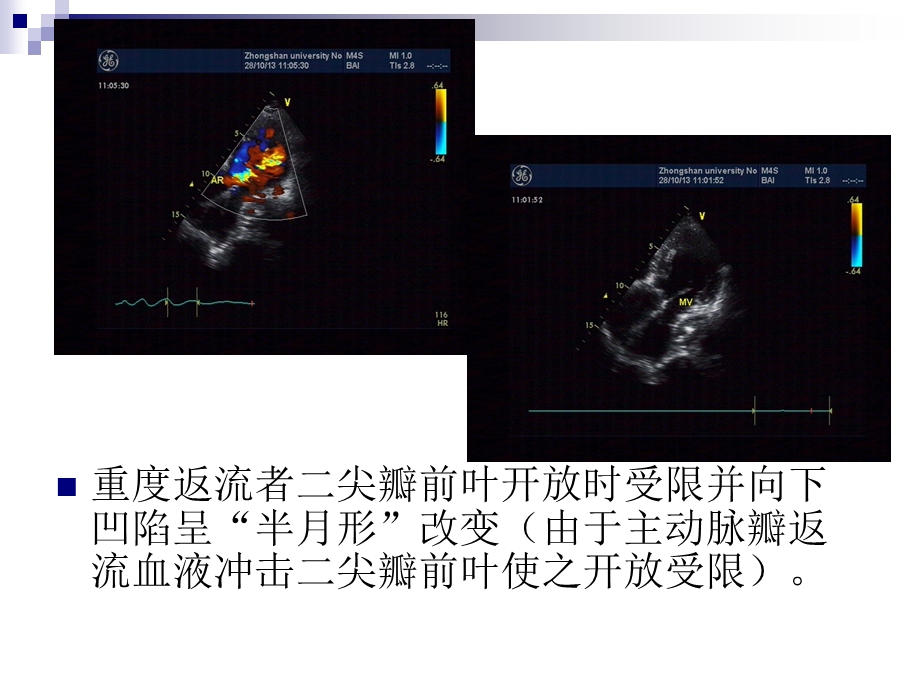 心脏瓣膜病的超声诊断第三部分课件.ppt_第3页