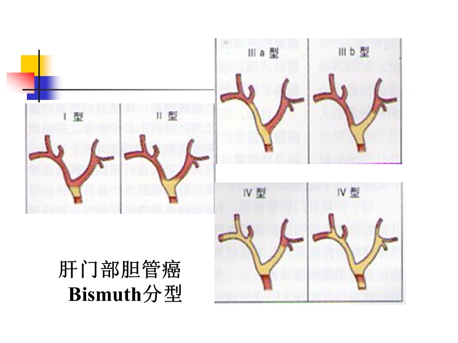 肝门部胆管癌的内镜治疗课件.ppt_第3页