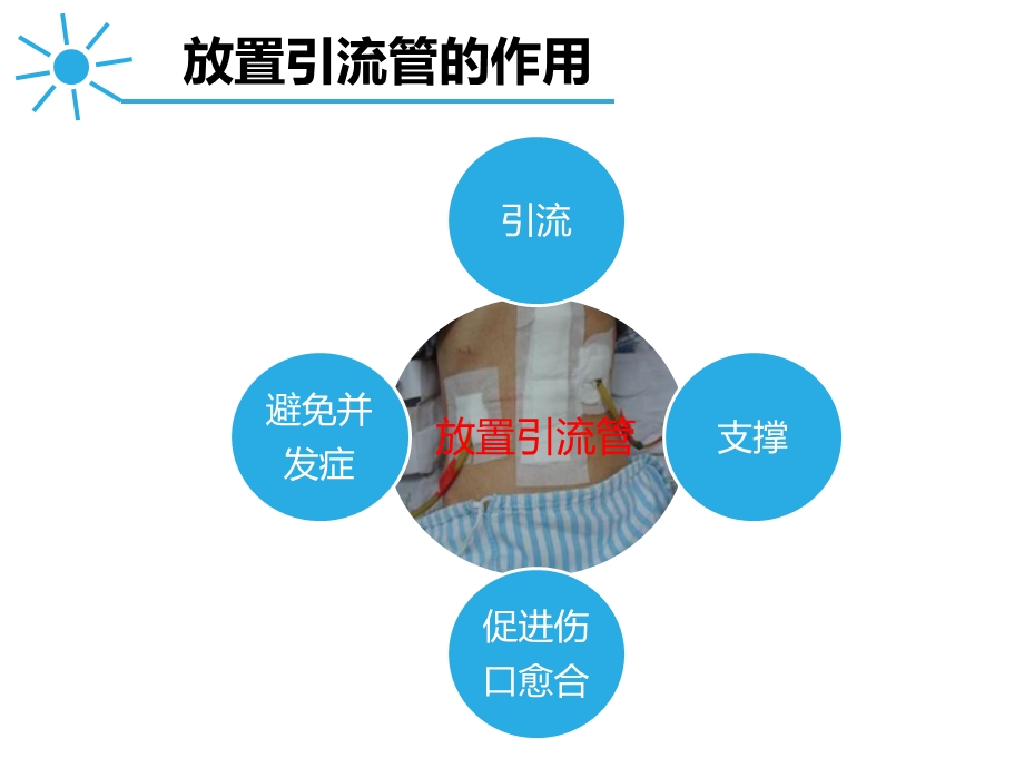 引流管冲洗的护理课件.ppt_第3页