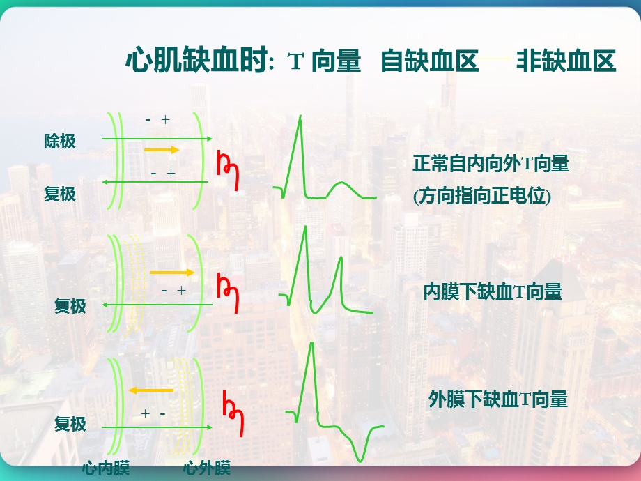 心肌缺血与心肌梗死的心电图改变课件.pptx_第3页