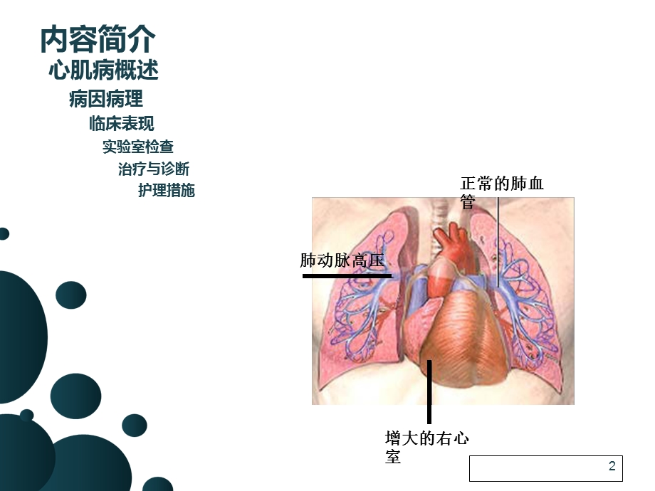 扩张性心肌病护理查房张性研究课件.ppt_第2页