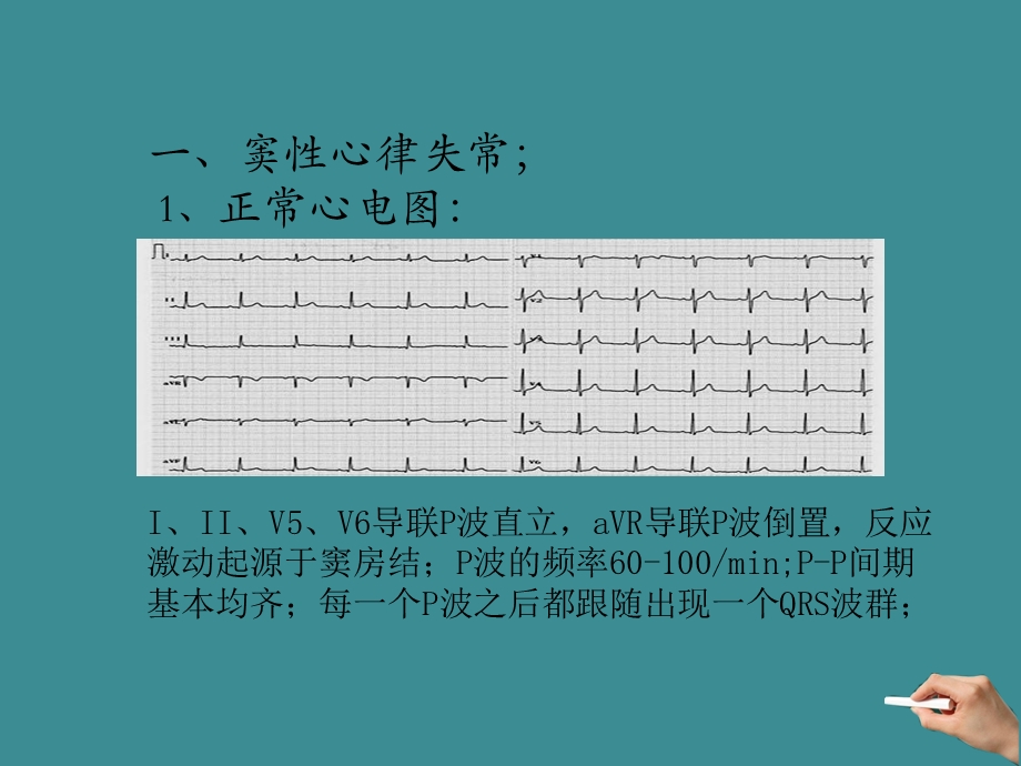 常见心电图解析课件.ppt_第3页