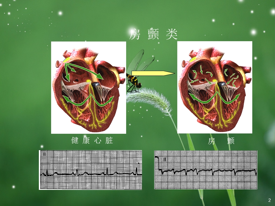 房扑与房颤心电图课件.ppt_第2页