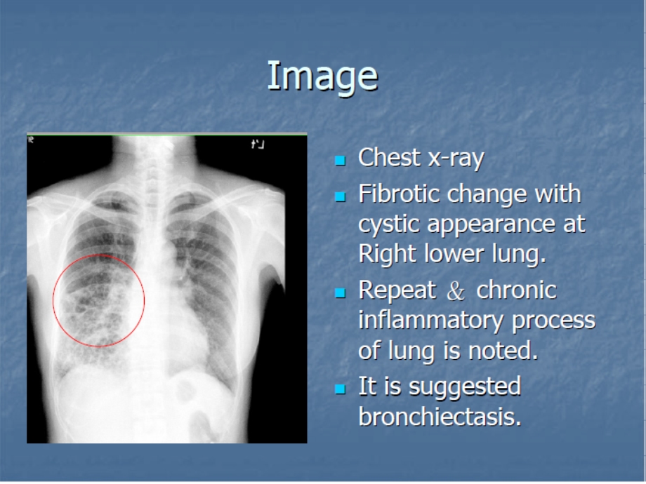 支气管扩张本科ppt课件.ppt_第2页