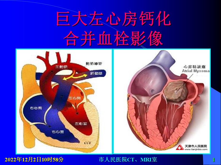 巨大左心房钙化合并血栓影像课件.ppt_第1页