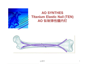 弹性髓内钉治疗儿童长骨骨折课件.ppt