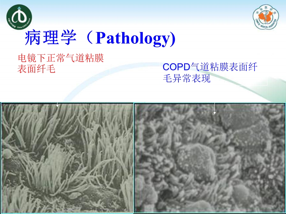 慢性支气管炎10.9班课件.ppt_第3页