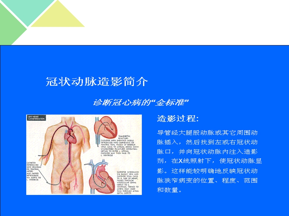 心脏介入治疗的简介课件.ppt_第3页