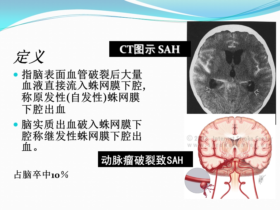 蛛网膜下腔出血诊治流程课件.pptx_第2页