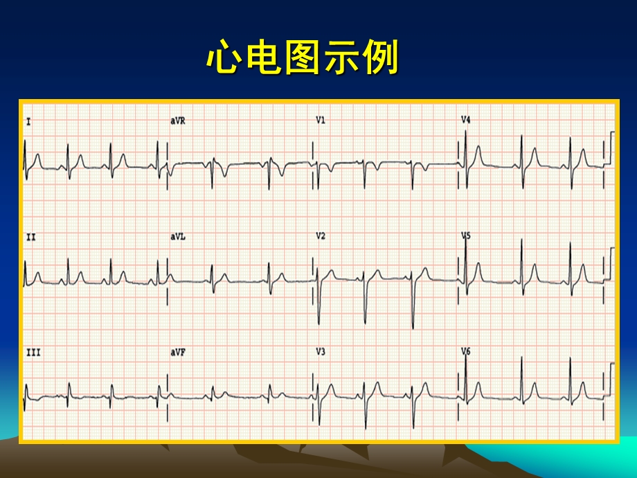 心电图考试辅导 2016 大学生临床技能竞赛课件.ppt_第2页