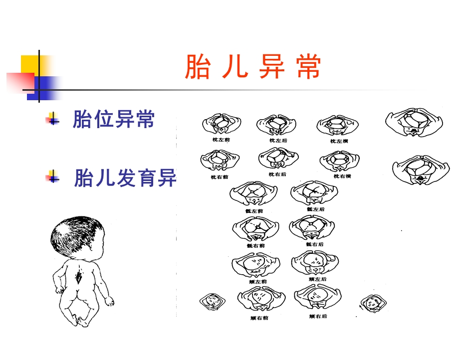 异常分娩、胎位异常课件.ppt_第3页