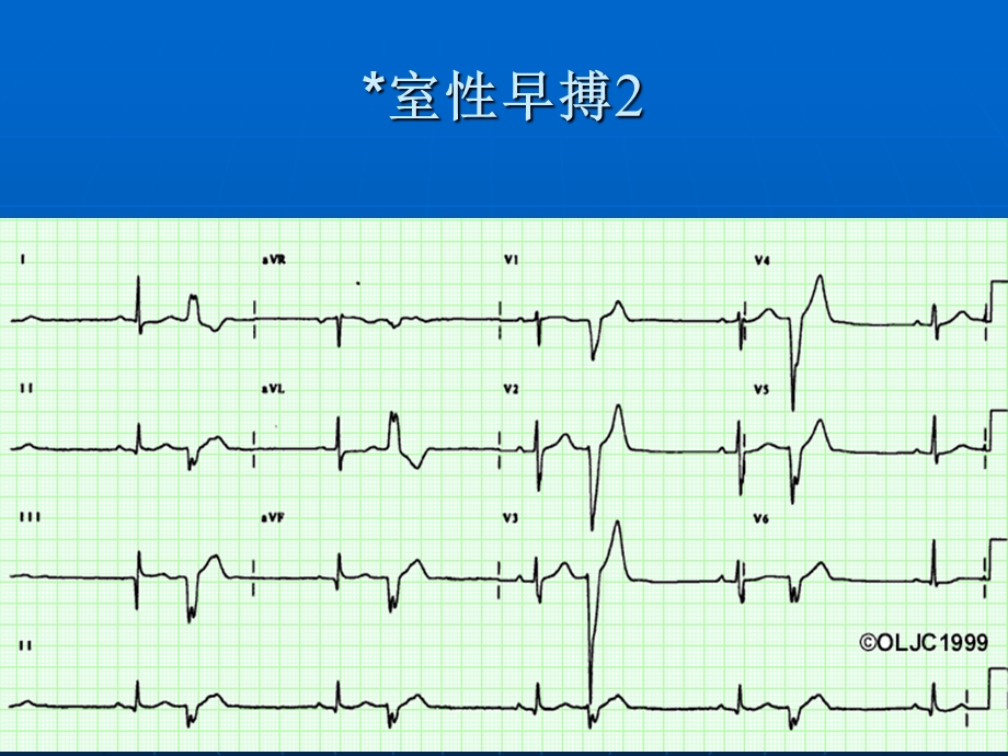 心电图识记课件.ppt_第3页