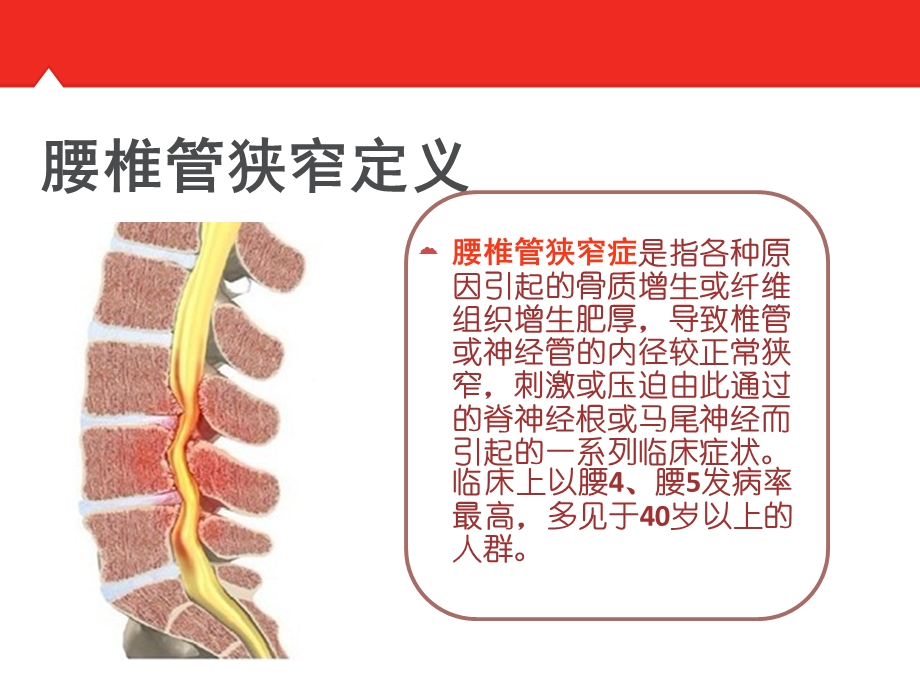 腰椎管狭窄护理查房课件.ppt_第3页