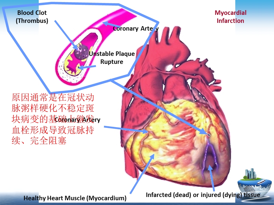 心肌梗死病理、病理生理和临床表现课件.ppt_第3页