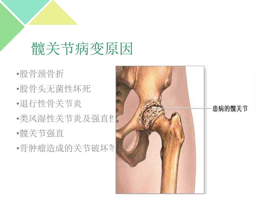 髋关节置换术后护理课件.ppt_第3页