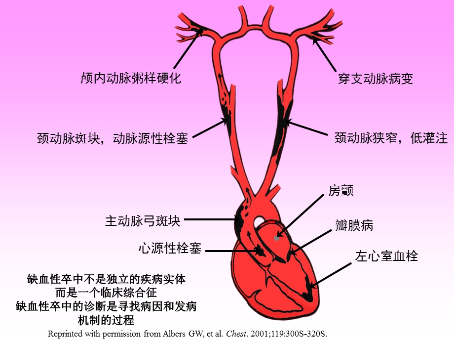 缺血性卒中病因及发病机制诊断课件.ppt_第2页