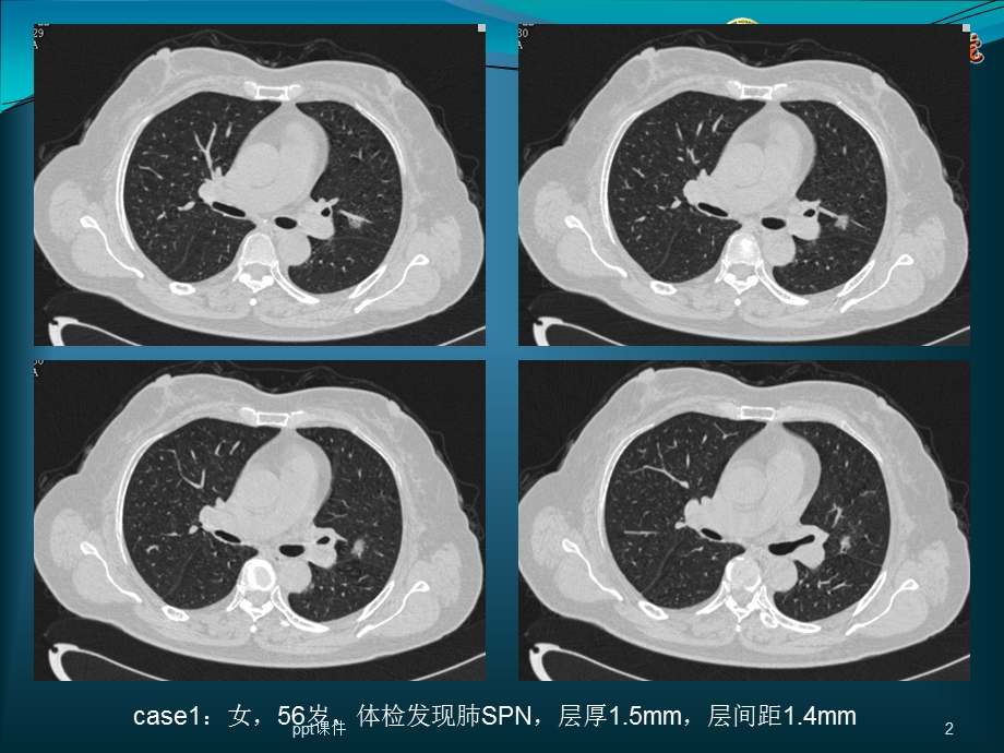 肺结节的检出与处理对策课件.ppt_第2页