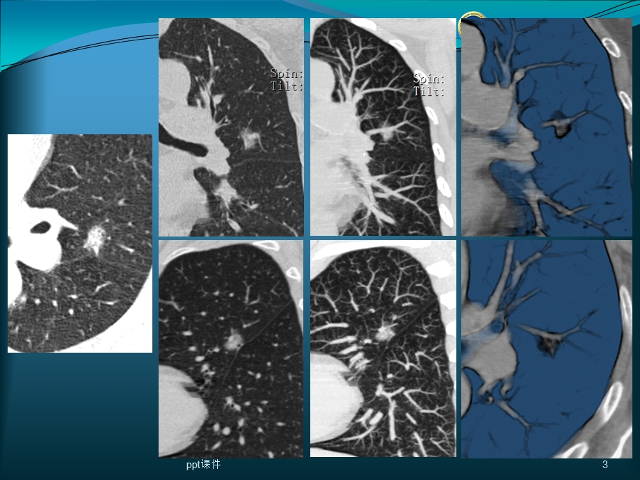 肺结节的检出与处理对策课件.ppt_第3页