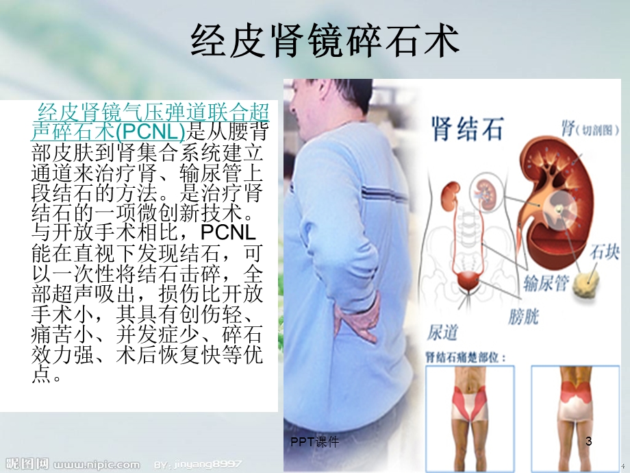 经皮肾镜手术配合课件.ppt_第3页