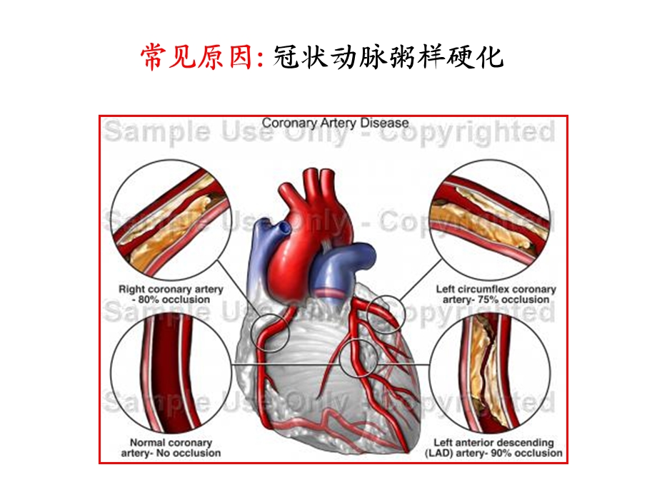 第28章 心绞痛课件.ppt_第3页