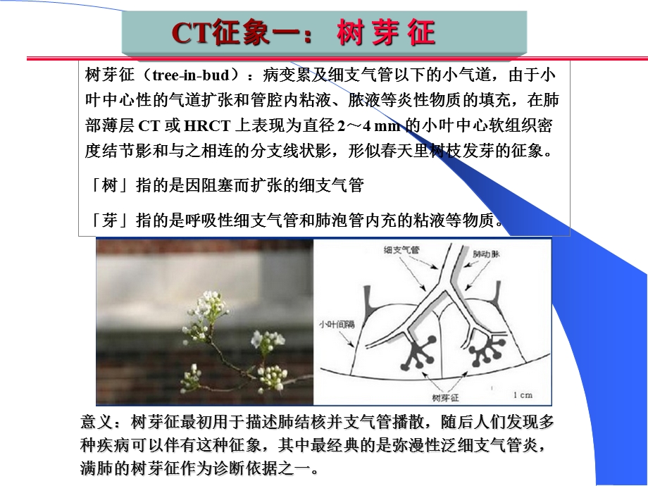 肺部CT十大征象诊断应用课件.ppt_第2页