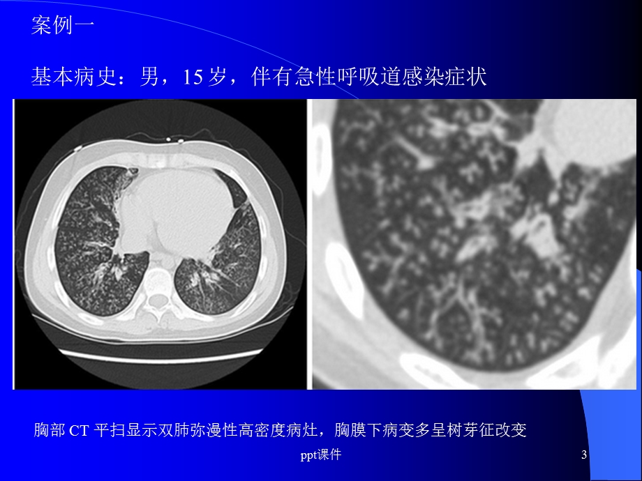 肺部CT十大征象诊断应用课件.ppt_第3页