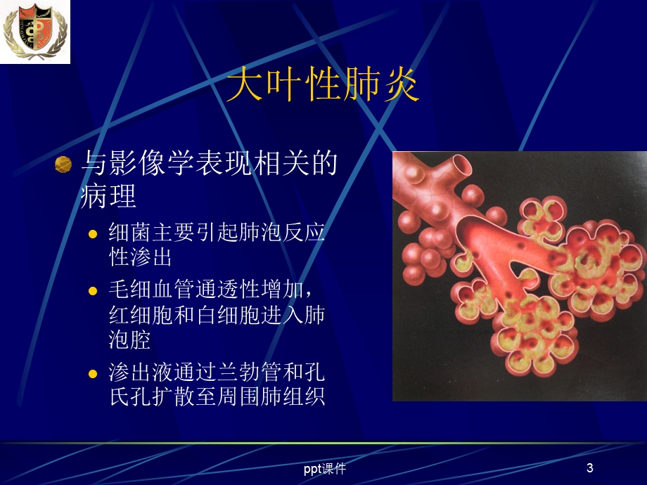 肺部炎症影像诊断课件.ppt_第3页