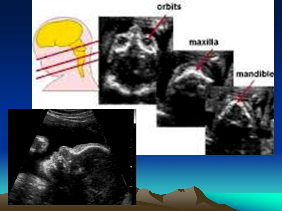 胎儿面部及颈部畸形的超声诊断课件.ppt_第3页