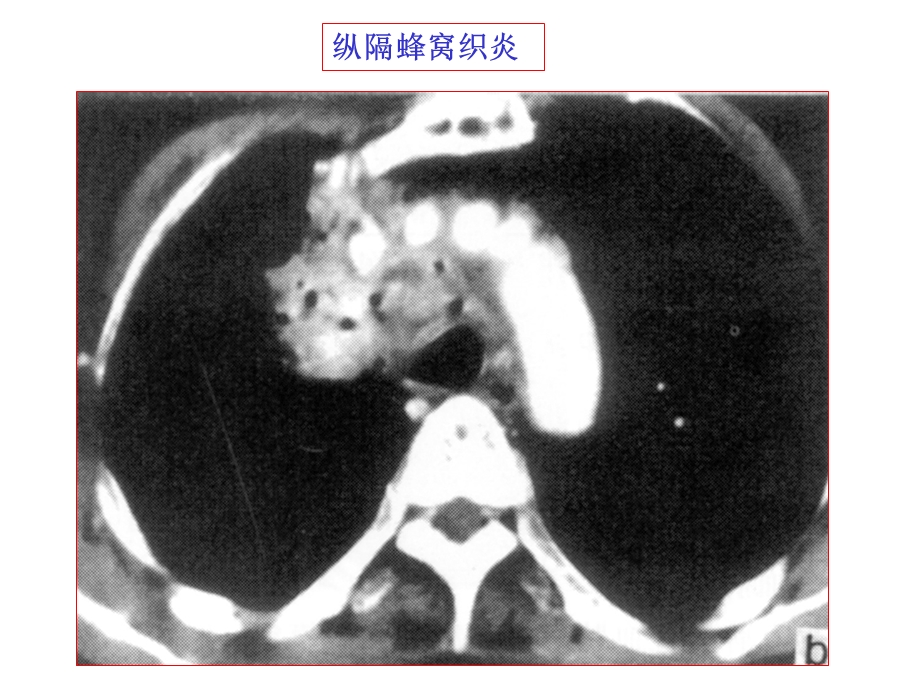 纵隔病变CT改变课件.ppt_第3页