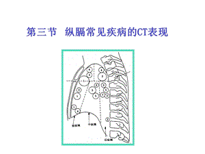 纵隔病变CT改变课件.ppt