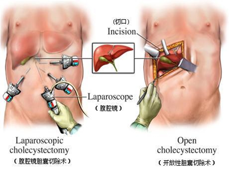 腹腔镜手术术前准备及术后护理课件.ppt_第3页