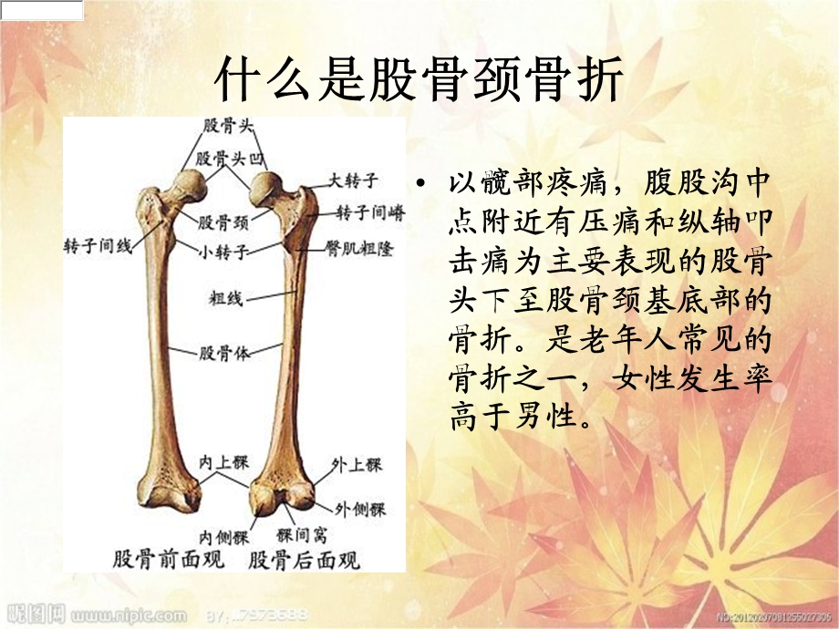 股骨颈骨折合并糖尿病的护理课件.ppt_第3页