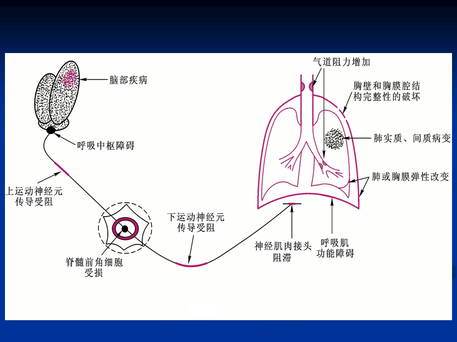 第十三章 呼吸衰竭 护理学课件.ppt_第3页