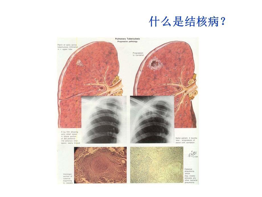 结核病防治知识讲座课件.pptx_第3页