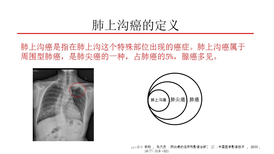 肺上沟癌的鉴别诊断课件.ppt_第3页