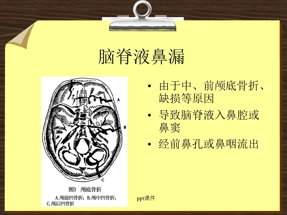 脑脊液鼻漏课件.ppt_第3页