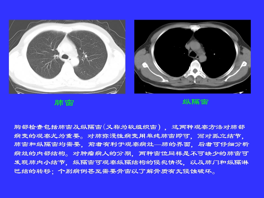 胸部CT阅读与诊断课件.ppt_第2页