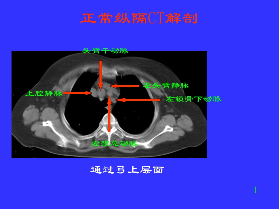 胸部CT阅读与诊断课件.ppt_第3页